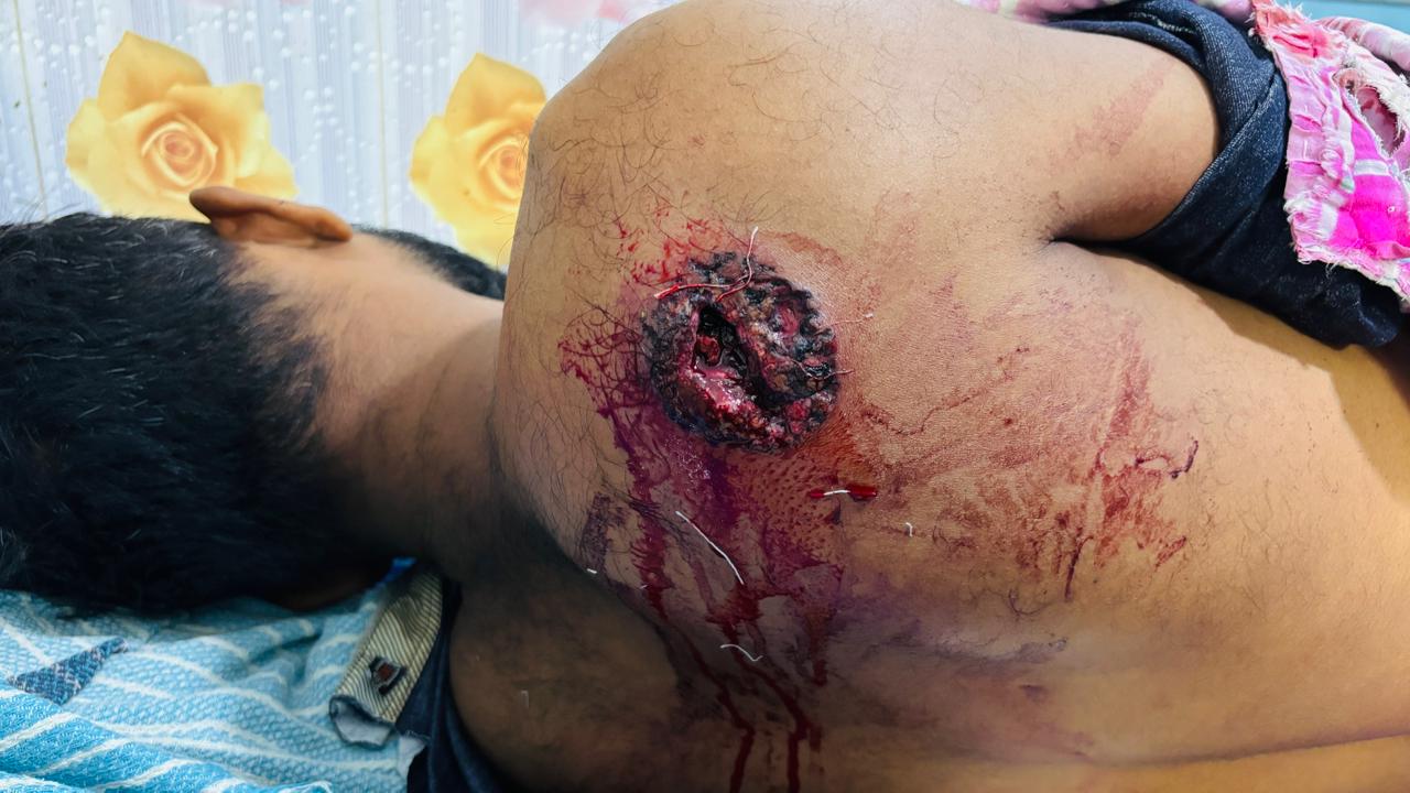 অবৈধভাবে দেশে ফেরার চেষ্টায় বিএসএফের গুলিতে আহত দুই শ্রমিক